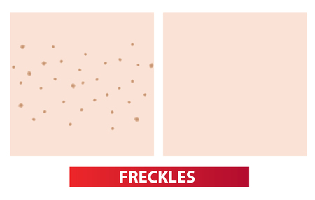 Freckles skin before and after vector illustrationのイラスト素材