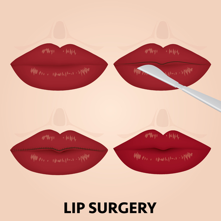 lip surgery before and after vector illustrationのイラスト素材