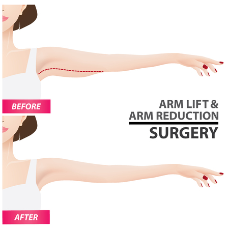 Arm lift and reduction surgery vector illustrationのイラスト素材