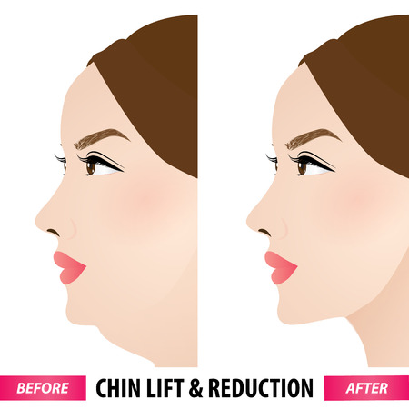 Double chin lift and reduction before and after vector illustrationのイラスト素材