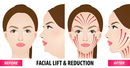 Facial lift and reduction before and after vector illustrationのイラスト素材