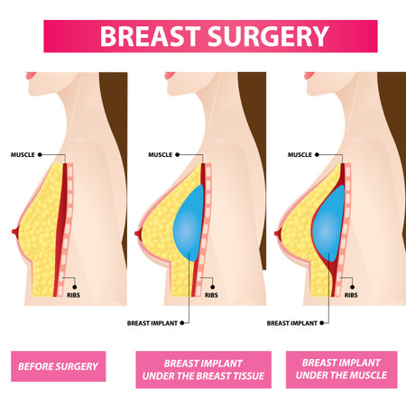 Plastic surgery of breast implant before and after vector illustrationのイラスト素材