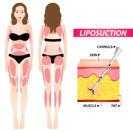 liposuction , woman fat surgery vector illustrationのイラスト素材