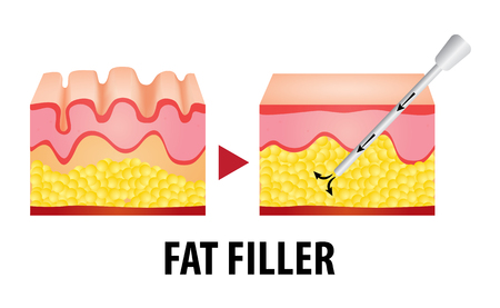 fat filler surgery vector illustrationのイラスト素材