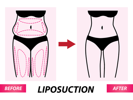 Liposuction , woman fat surgery before and after vector illustrationのイラスト素材