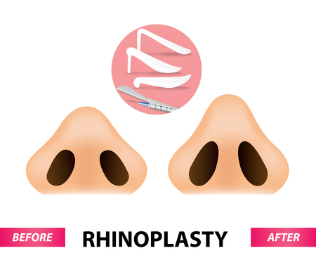 Rhinoplasty surgery vectorのイラスト素材