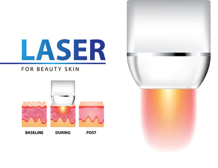 Laser for anti aging vector illustrationのイラスト素材