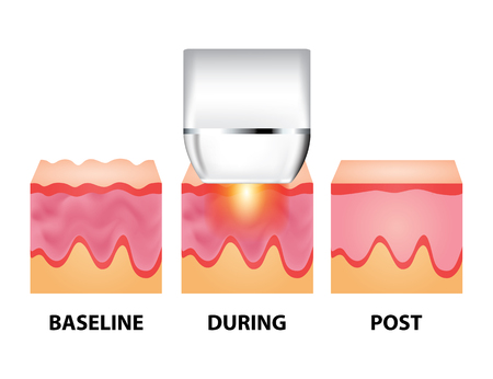 Laser for anti aging vector illustrationのイラスト素材