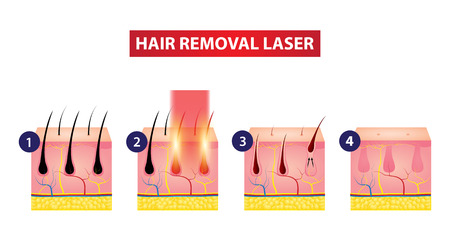 Hair removal laser icon step vector illustrationのイラスト素材
