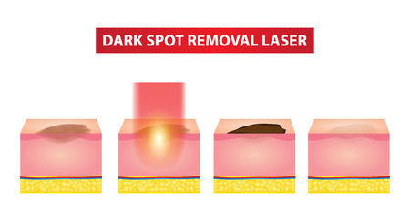 Dark spot laser steps vector illustrationのイラスト素材