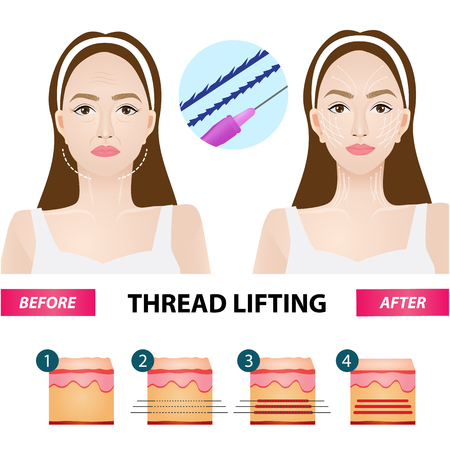 Thread lifting vector illustrationのイラスト素材