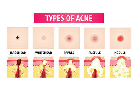 types of acne vector illustrationのイラスト素材