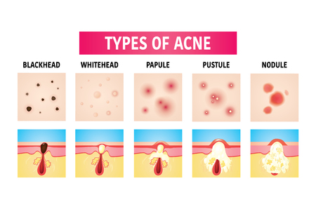types of acne vector illustrationのイラスト素材