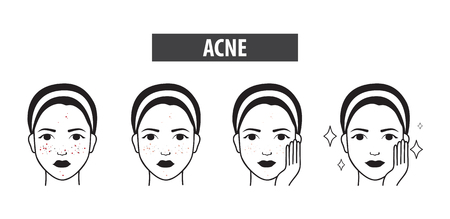 Acne skin icon of woman to clear steps vector illustrationのイラスト素材
