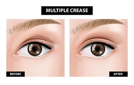 Multiple crease of eyelid ,before and after vector illustrationのイラスト素材