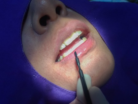 In-Office Professional Teeth Whitening procedure of dentist apply the protective lip balm to Asian...
