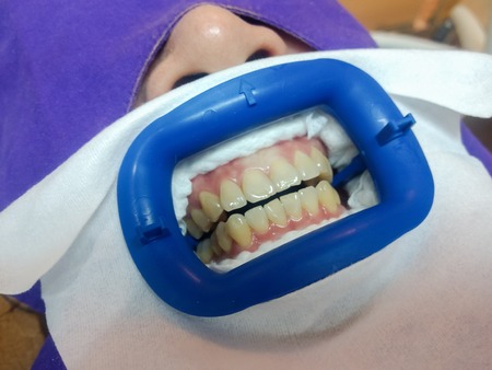 Asian woman patient who prefer Whiter teeth with cheek retractor on, ready for in-Office Professional Teeth Whitening procedure.の写真素材