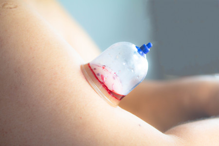 Chinese medical arm blood cupping bleedingの写真素材