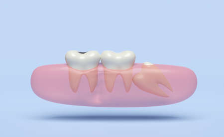3d wisdom teeth model problems icon with gums isolated on blue background. dental examination of the dentist, health of white teeth, oral care, 3d render illustrationの写真素材