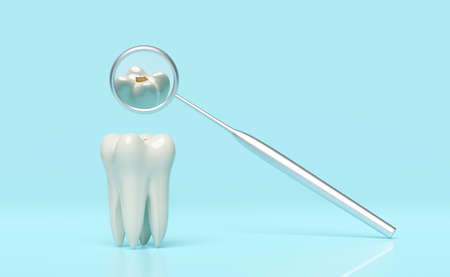 dental molar teeth model icon check for cavities 3d with dentist mirror isolated on blue background. health of white teeth, dental examination of the dentist, 3d render illustrationの写真素材