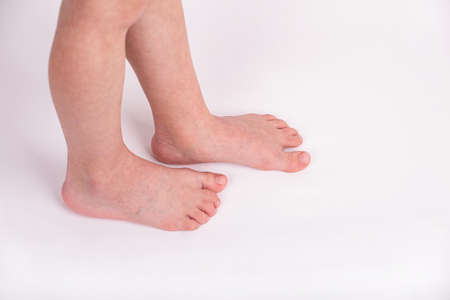 syndactyly. Fused toes of a child, on a light backgroundの写真素材