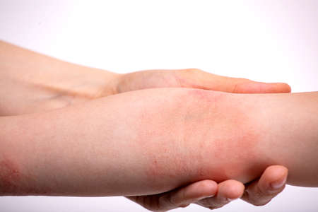 The hand of a child with atopic dermatitis