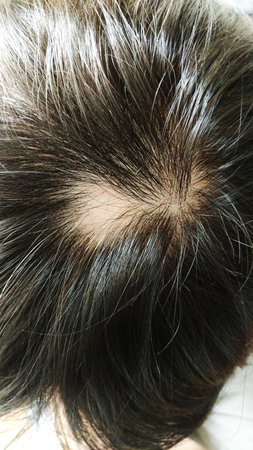  alopecia areata hair fall problemの写真素材