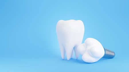 3d render of dental implant on blue background