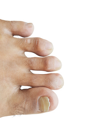 Closeup man's toe nails are going to fall isolated on white background.の写真素材