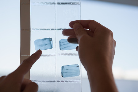 Dentists looking and pointing to xray at the dental clinicの写真素材