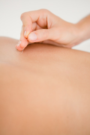 Close up view of woman holding a needle in an acupuncture therapyの写真素材