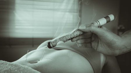 Young woman getting acupuncture treatment in therapy roomの写真素材