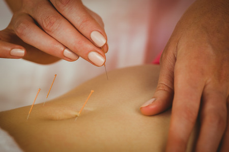 Young woman getting acupuncture treatment in therapy roomの写真素材