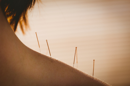 Young woman getting acupuncture treatment in therapy roomの写真素材