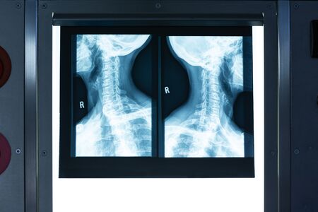 Close-up of x-ray a neck in light box in operating room at hospital. Shot in real medical hospital...
