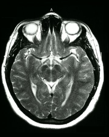An MRI (Magnetic Resonance Image) of the brain