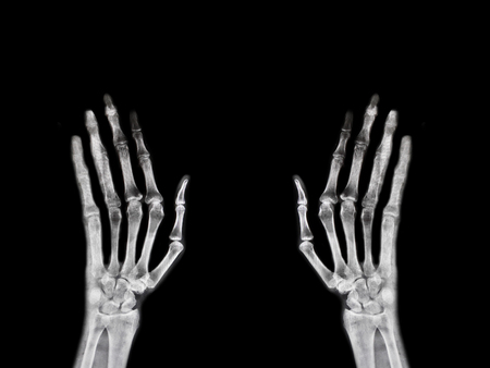 Hand x-rayの写真素材