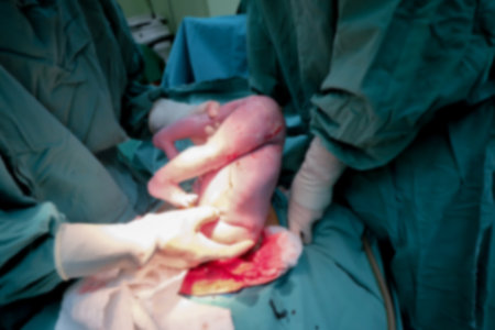 cesarean pregnancy mother in operation room giving birth baby wrong position out from bottomの写真素材