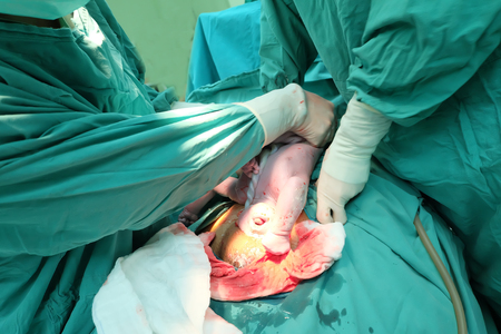 cesarean pregnancy mother in operation room giving birth baby wrong position out from bottomの写真素材