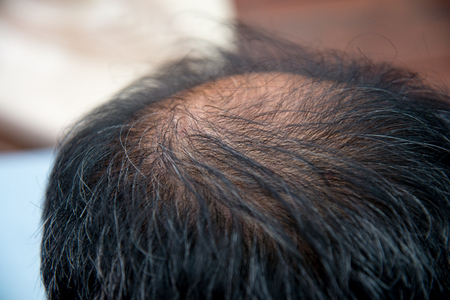 Close up  of man hair lose , glabrousの写真素材