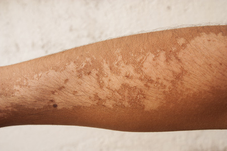 Show of sunburn effects on the arms with white wall background