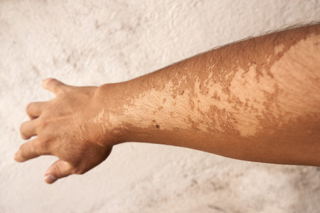 Show of sunburn effects on the arms with white wall backgroundの写真素材