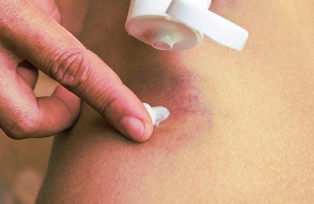 Cropped image of a young woman putting moisturizer onto her finger on a great hematoma