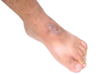 Infectious wound on foot