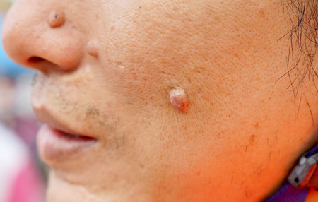 Mole on face and noseの写真素材