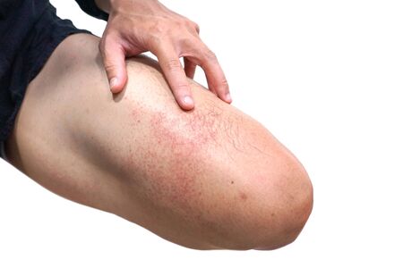 Red rash on leg isolated on white background / Rashes with virusの写真素材
