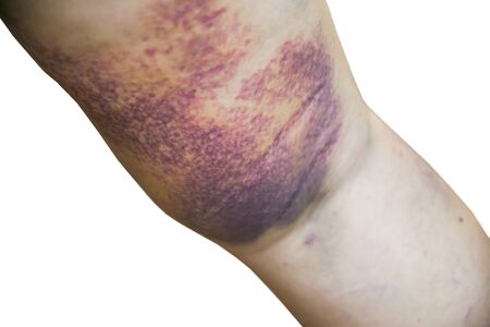 Old female's leg full of bruise isolated on whiteの写真素材