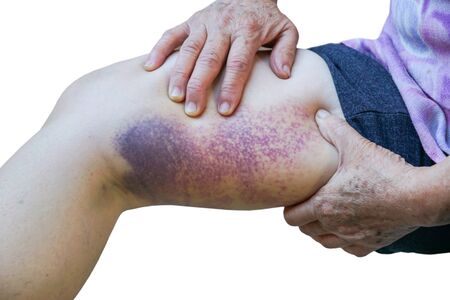 Old female's leg full of bruise isolated on whiteの写真素材