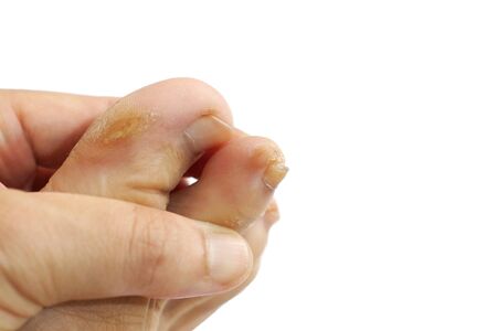 Runner's toes problem isolated on white backgroundの写真素材