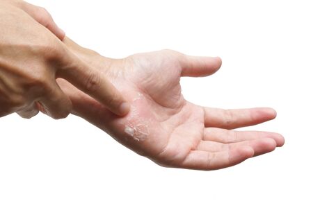 Hand skin peeling isolated on white background